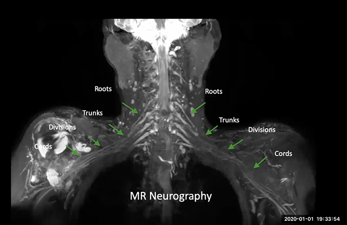 Mri Neurography