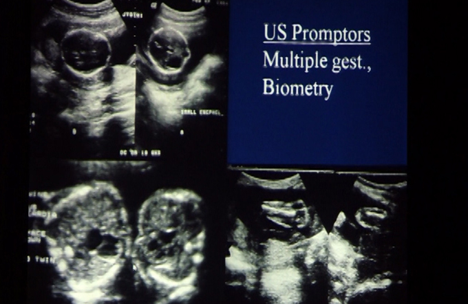 crl ultrasound คือ side effects